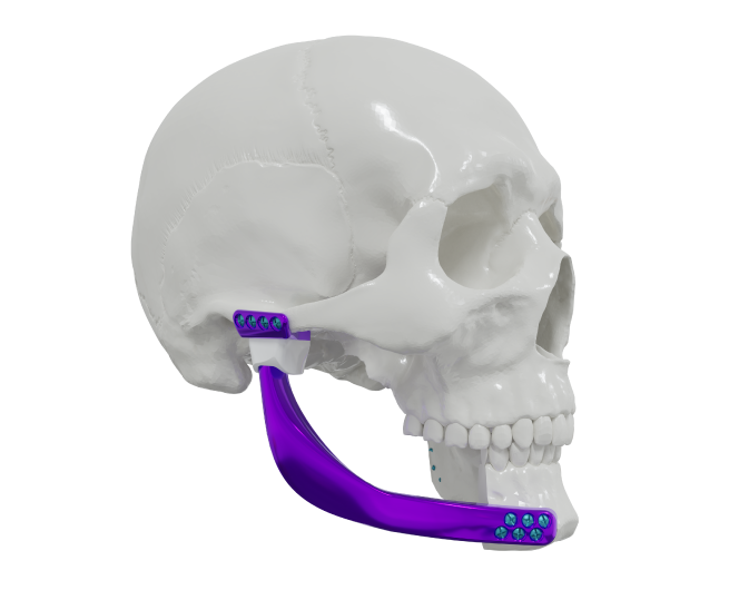 Prótese Mandibular Maxilar Tudo Sobre Sistema Suportado Por, mandibula e  maxilar 